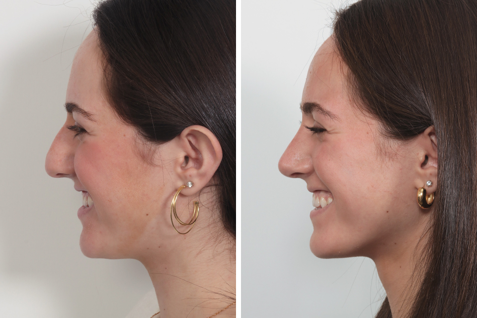 Rhinoplasty