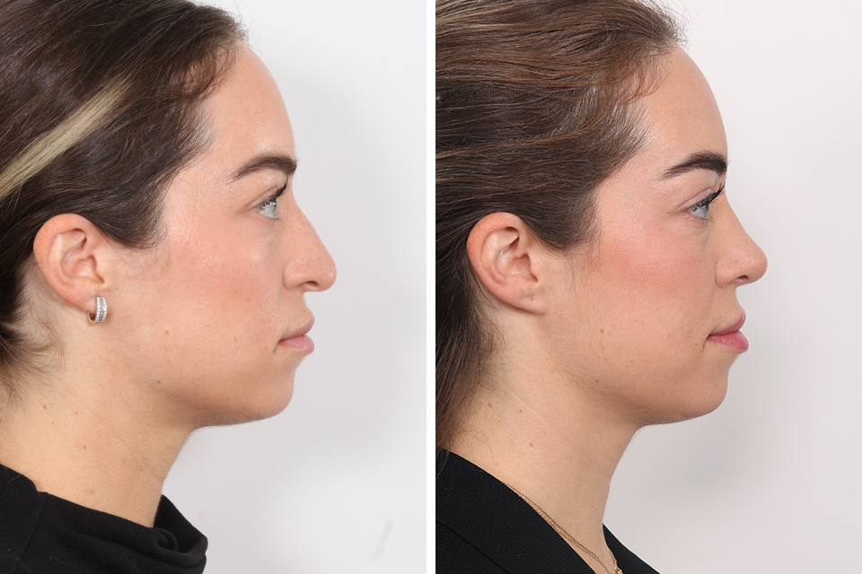 Rhinoplasty